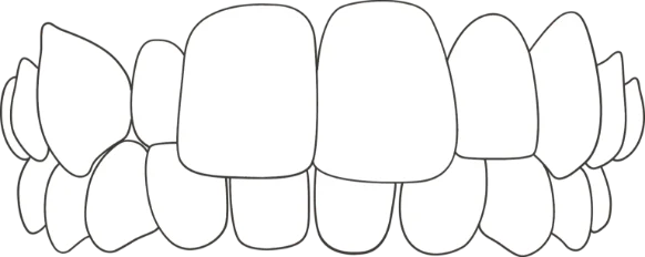 Crossbite