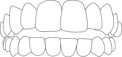 Open bite