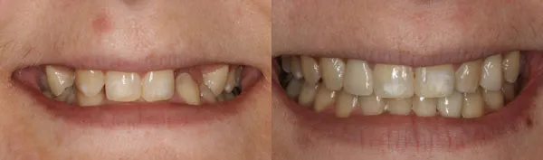 adult patient missing several teeth