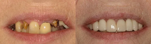 adult patient requiring functional and restorative treatments image