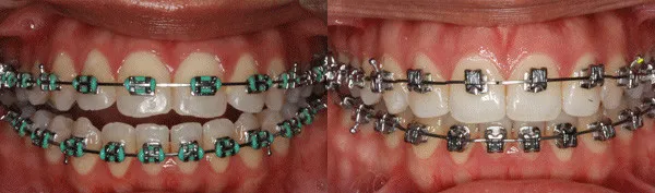 adult patient with incorrectly placed braces