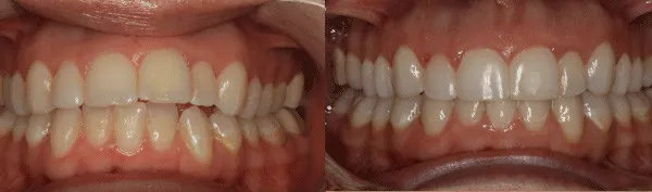 adult patient with missing teeth and misalignment issues image