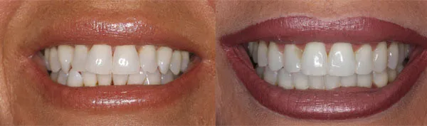 adult with misaligned bite