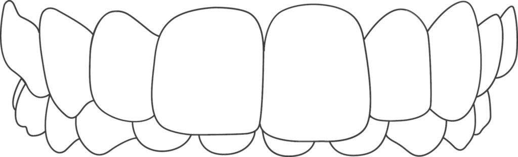 overbite