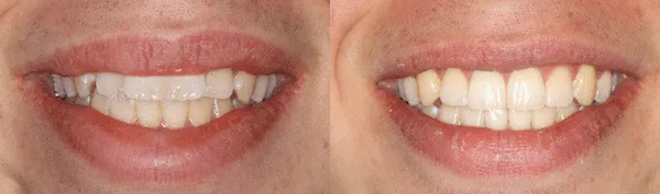 teen patient with misalignment issues
