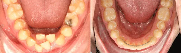 teen patient with severe lower jaw crowding