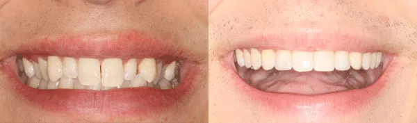teen with undersized small upper. lateral incisors