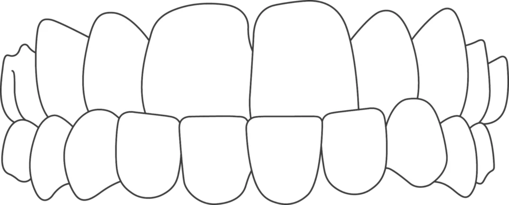 underbite